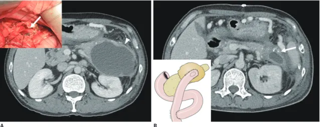Fig. 12. Computed tomography (CT) and schema of cystojejunostomy. 