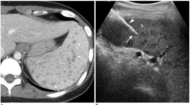 Fig. 4. 20-year-old woman with multiple microabscesses in spleen.