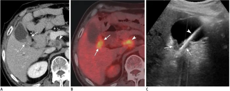 Fig. 6. 77-year-old man with GB cancer.