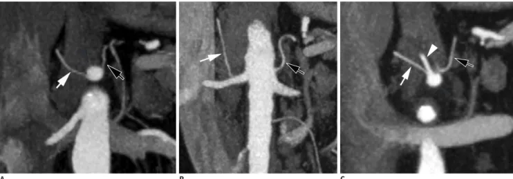 Fig. 6. CT angiography MIP image shows left inferior phrenic  artery (black arrow) arising from back of aorta