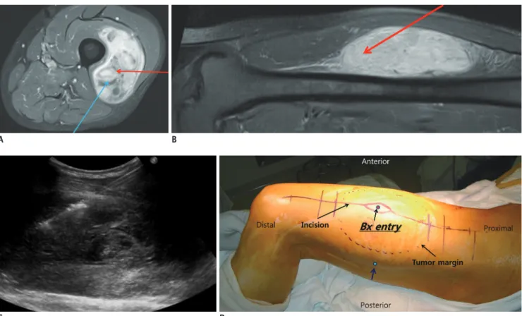 Fig. 5. 81-year-old female patient with mass in her left upper  arm.  On axial enhanced T1-weighted image, there is homogeneously  enhancing, solid mass that involves biceps brachii muscle
