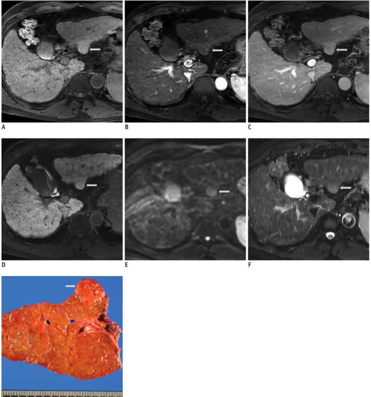 Fig. 5. Moderately differentiated HCC in 60-year-old man. 