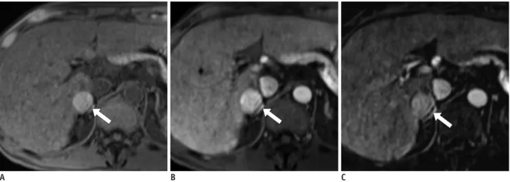 Fig. 1. HCC in 56-year-old man.