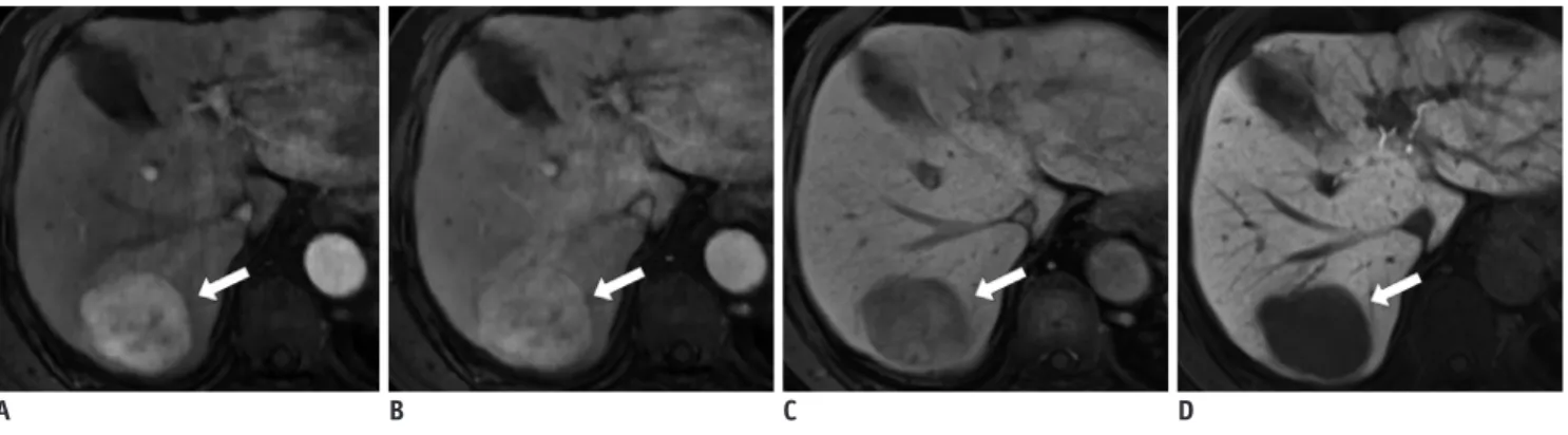 Fig. 2. HCC in 82-year-old man with chronic hepatitis C.