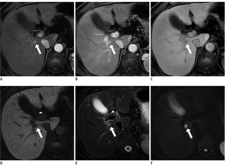 Fig. 3. Sub-centimeter-sized HCC in 56-year-old man with chronic hepatitis B. 