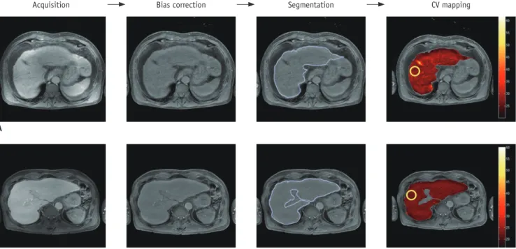 Fig. 1. Workflow for calculation of coefficients of variation (CV) in control subject (A) and in patient with chronic hepatitis  B (B) in hepatobiliary phase of Gd-EOB-DTPA-enhanced MRI