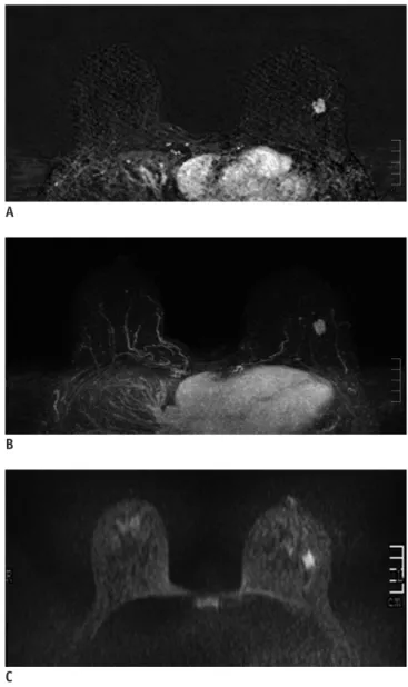 Fig. 1. 40-year-old woman with dense breast tissue.