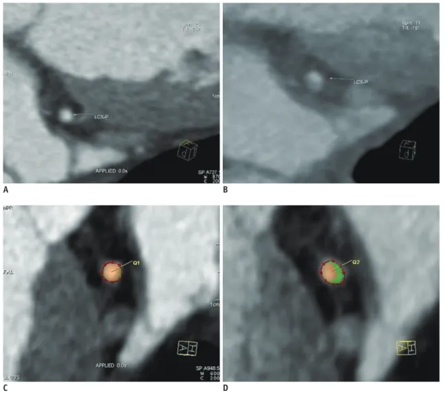 Fig. 2. Assessment of plaque progression by CCTA. 