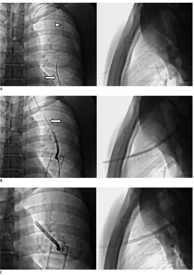 Fig. 2. Thoracic vent insertion under fluoroscopic guidance.