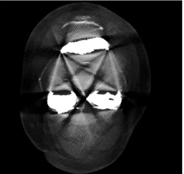 Fig. 7. Metal implants in pelvis.  Little artifact without obvious  distortion and clear cancellous bone were shown