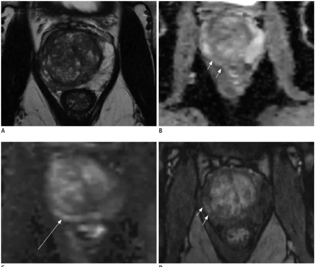 Fig. 1. 61-year-old male with fluctuating PSA and current PSA level of 7.5 ng/mL.  Prior biopsy session revealed no prostate cancer