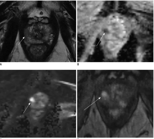 Fig. 3. 62-year-old male with PSA level of 5.6 ng/mL. 
