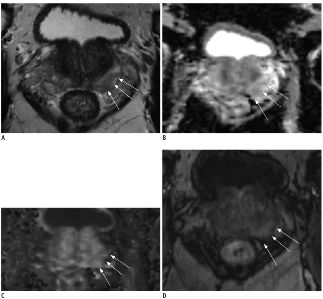 Fig. 6. 64-year-old male with PSA level of 4.9 ng/mL. 