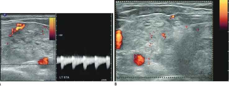 Fig. 3. Ablation of feeding artery.