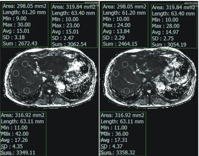 Fig. 2. T2* values were calculated in pre- and post-contrast T2* maps by drawing three circular ROIs in liver parenchyma while  avoiding focal hepatic lesions, major branches of portal or hepatic veins, or imaging artifacts