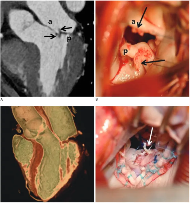 Fig. 11. 57-year-old woman who presented with necrosis of left toe and finger.  Pre-operative cardiac CT was obtained to evaluate MV  and rule out infective endocarditis with vegetation