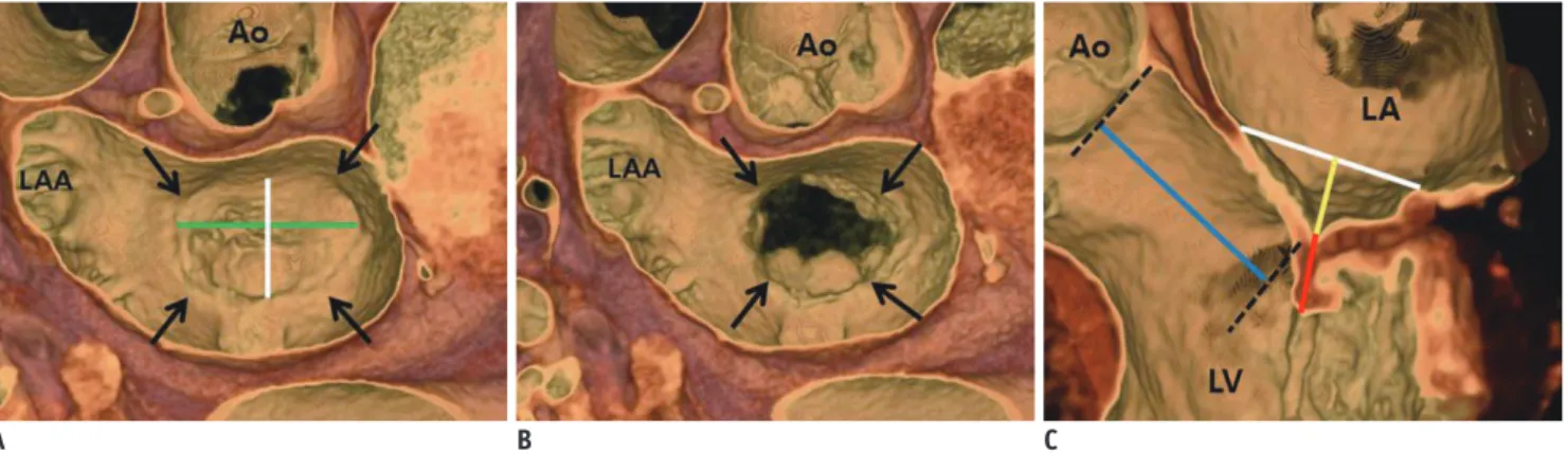 Fig. 2. MV coaptation geometry.