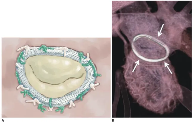 Fig. 4. Carpentier-Edwards Physio annuloplasty ring.