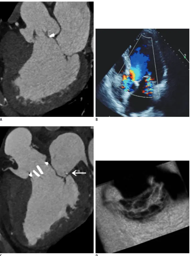 Fig. 10. 63-year-old man who presented with exertional dyspnea.