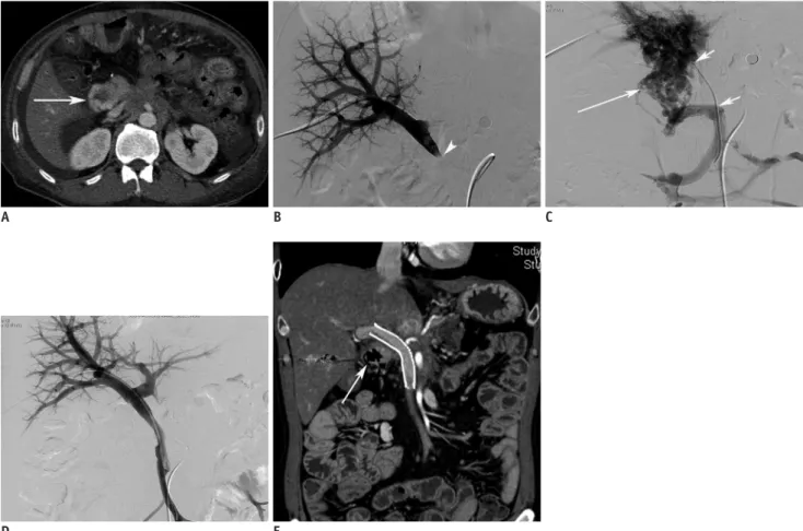 Fig. 1. 53-year-old man with hematochezia.  Patient underwent pylorus-preserving pancreaticoduodenectomy due to pancreatic cancer 737  days ago.