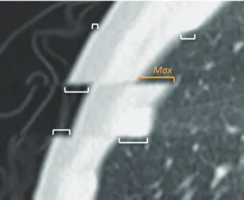 Fig. 2. Measurement of respiratory misregistration artifacts  between imaging slabs on sagittal formatted lung CT image