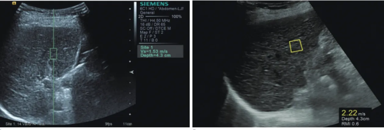 Fig. 2. LS measurement by two pSWE techniques, VTQ (A) and S-Shearwave (B).  For both measurements, operator sited predefined  measurement box in liver