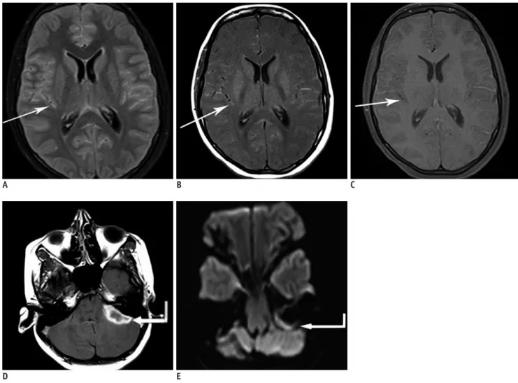 Fig. 3. MR imaging in 17-year-old female with pyogenic meningitis. 