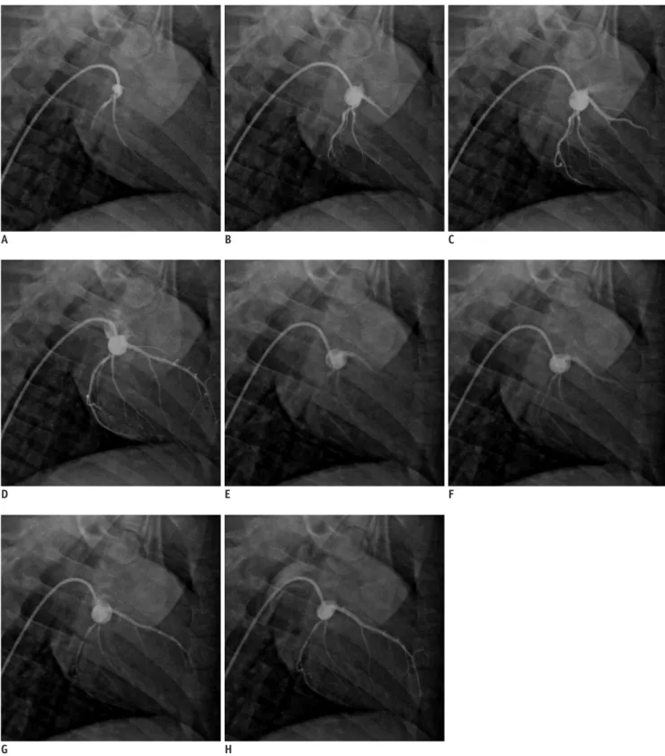 Fig. 1. Coronary angiograms pre- and post-coronary microembolization. 
