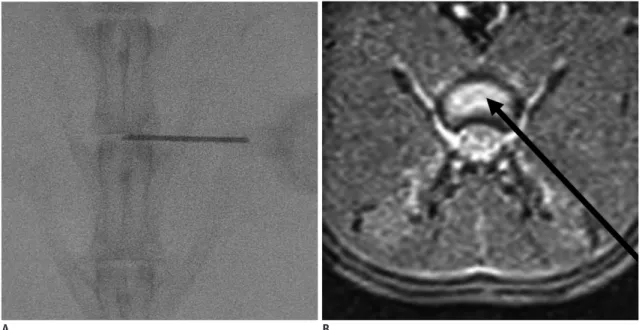 Fig. 1. Fluoroscopic guided annular puncture of lumbar intervertebral disc in rabbit.