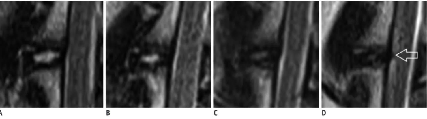 Fig. 2. Pfirrmann grade 1 to grade 4 discs assessed with MR T2-weighted sagittal scan.