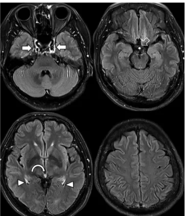 Fig. 3. Parenchymal metastasis from breast cancer. 