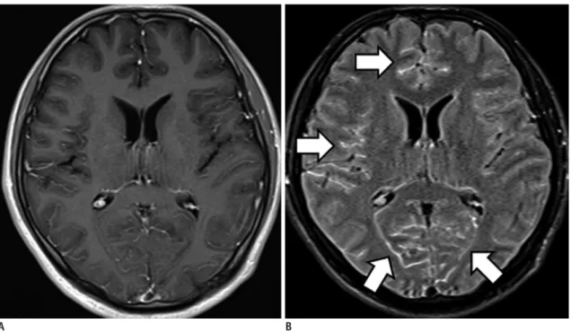 Fig. 4. Viral meningoencephalitis. 