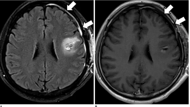 Fig. 9. Postoperative dural enhancement after surgery of cavernous hemangioma. 