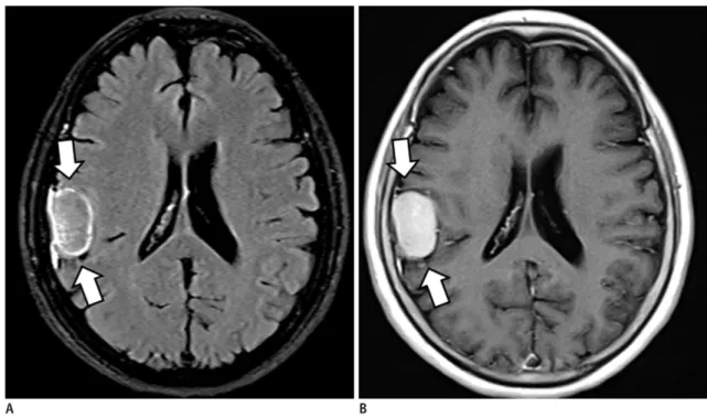 Fig. 12. Meningioma of fibroblastic type, WHO grade 1. 
