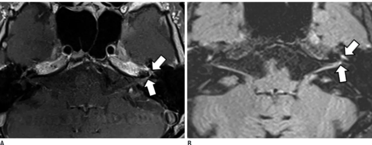 Fig. 13. Left facial neuritis. 