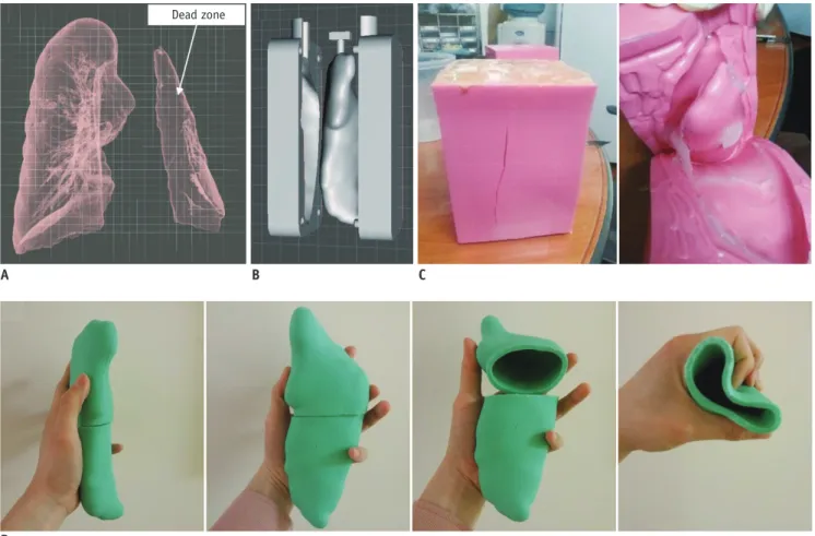Fig. 12. Pilot study of patient-specific implant device with flexible material.