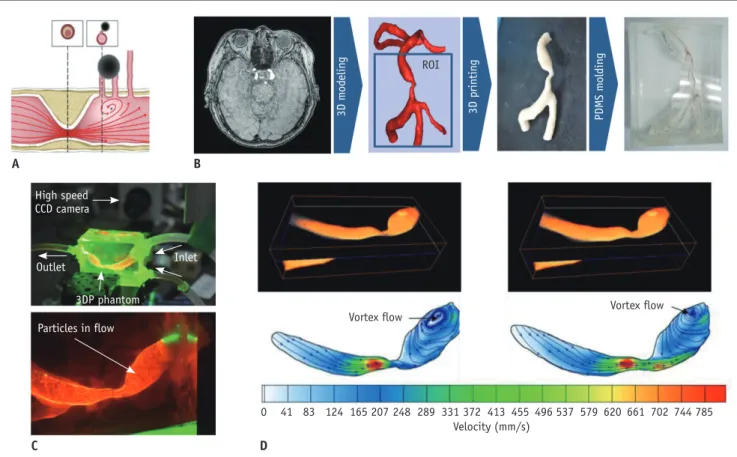Fig. 14. Fluid dynamic study of paramedian pontine infarction.