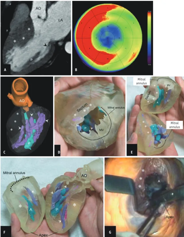 Fig. 9. 3D-printed simulator for extended septal myectomy.