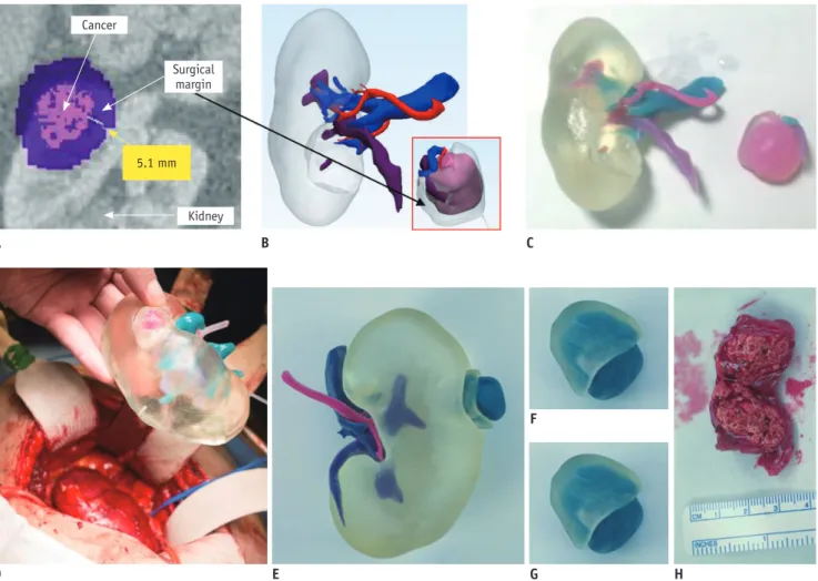 Fig. 10. 3DP application in partial nephrectomy.
