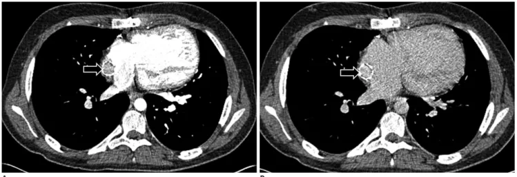 Fig. 2. 16-year-old boy with history of double outlet right ventricle status post Fontan procedure who presented with shortness  of breath