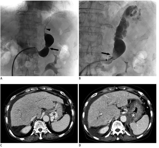 Fig. 1. 72-year-old female with GV and GRS. 