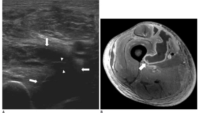 Fig. 2. Infectious pyomyositis with intramuscular abscess due to Staphylococcus aureus in 36-year-old patient with right thigh  pain and fever