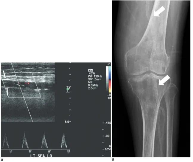 Fig. 5. Medial arteriosclerosis showing stiff Doppler flow pattern in lower extremity in 60-year-old patient