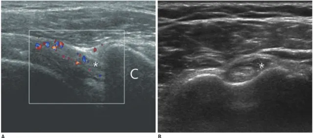 Fig. 8. Adhesive capsulitis of right shoulder in 49-year-old patient with bilateral shoulder pain