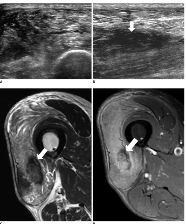 Fig. 11. Diabetic muscle infarction affecting right thigh in 55-year-old patient with leg pain