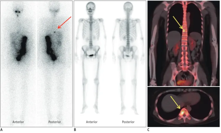 Fig. 1. True positive finding of bone PET/CT. 