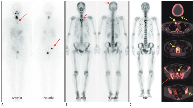 Fig. 2. True positive findings of bone PET/CT. 