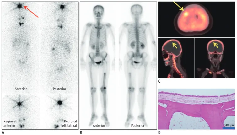 Fig. 3. False positive finding of bone PET/CT. 