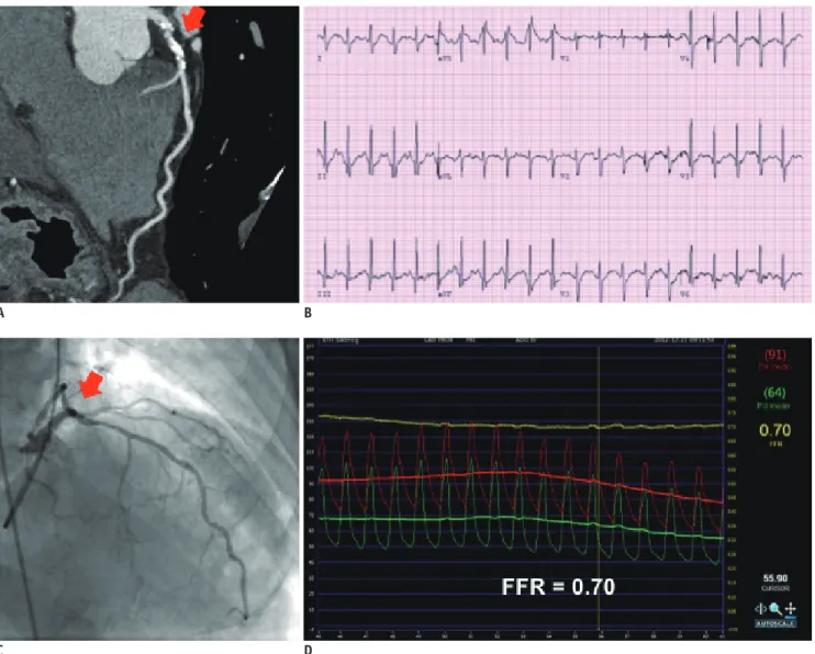 Fig. 3. Case with discrepancy between exercise stress test and fractional flow reserve (FFR).