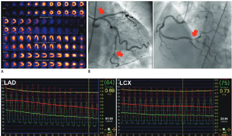Fig. 4. Case with discrepancy between myocardial perfusion imaging and fractional flow reserve